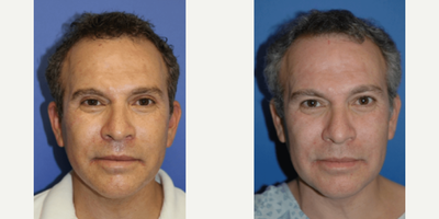 Man treated with Facelift - Man treated with Facelift
