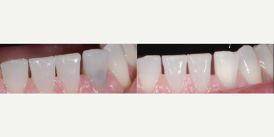 25-34 year old woman treated with Internal Tooth Bleaching - Internal bleaching