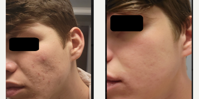 25-34 year old man treated with Retin-A, Accutane - Retin-A works by promoting the turnover of skin cells, which helps to prevent the clogging of pores and reduce the formation of acne lesions. It can also help to reduce the appearance of fine wrinkles and mottled skin discoloration, and to make rough facial skin feel smoother.While Retin-A can be very effective, it can also cause side effects, including skin redness, dryness, itching, scaling, mild burning, or worsening of acne during the first 2 to 4 weeks of using the medication. These side effects usually decrease with continued use of the medication.It's important to use Retin-A exactly as directed by your physician and to avoid exposure to sunlight or artificial UV rays, such as sunlamps or tanning beds, while using the medication, as it can make your skin more sensitive to UV rays.