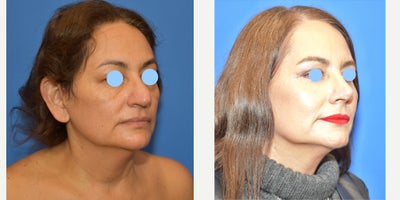 55-64 year old woman treated with Rhinoplasty, Eyelid Surgery - Women treated with Rhinoplasty and Lowe eyelid surgery