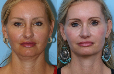 Woman Treated with Facelift - This patient was concerned with early signs of aging in her neck and jowl. She had a mini-facelift and lower eyelid skin pinch to bring back her sharp neckline and rejuvenate her eyes.