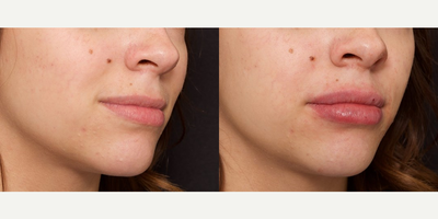 Woman treated with Lip Fillers - Woman treated with Lip Fillers