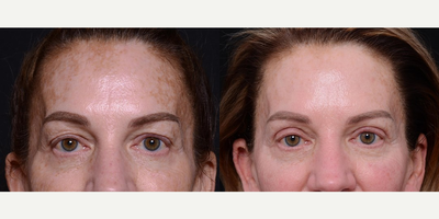 Woman treated with Chemical Peel - Woman treated with Chemical Peel
