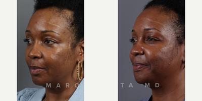 Woman treated with Scar Removal - Geometric broken line closure, sculpted to refine a scar on our patients cheek. Precise incisions, meticulous tissue alignment, and fine sutures converge in a personalized transformation. Swipe left to witness the powerful before-and-after.