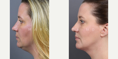 Woman treated with Chin Liposuction - Submental Liposuction with Renuvion. Swipe left to witness the stunning before-and-after photos of our satisfied patient! Our patient underwent submental liposuction, a minimally invasive procedure targeting excess fat beneath the chin. But thats not all  we took it a step further with Renuvion, a cutting-edge technology for skin tightening.
