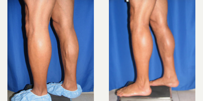 Man treated with Calf Implant - Man treated with Calf Implant