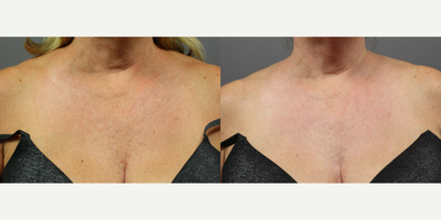 55-64 year old woman treated with ResurFX - 4 Treatments of Photofractional