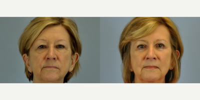 65-74 year old woman treated with Eyelid Surgery - This patient had bilateral upper and lower eyelid surgery called blepharoplasty along with bilateral canthopexy.