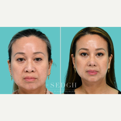 45-54 year old woman treated with Rhinoplasty, Asian Rhinoplasty - There are many approaches to rhinoplasty. My patient had been contemplating her options and wanted a more refined, projected tipwithout altering the character of her nose. Maintaining authenticity was her top priority, and at just 3 months post-op, its clear we achieved that. The enhanced tip projection and definition created a truly transformational improvement from every angle. Thats how important proper nasal tip projection is in facial aesthetics.