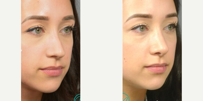Woman treated with Revision Rhinoplasty - After having a primary rhinoplasty procedure with another surgeon, she still desired correction of the residual dorsal hump as well as a bit more rotation and definition of the nasal tip.