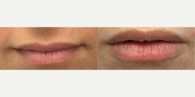 Woman treated with Lip Fillers - Woman treated with Lip Fillers