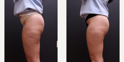 45-54 year old woman treated with Aveli - One treatment of Aveli to treat cellulite on patients buttocks and thighs.