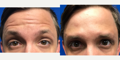 25-34 year old man treated with Injectable Fillers - Botox injection in the forehead and between the brows to reduce wrinkles.