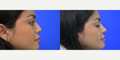 25-34 year old woman treated with Nonsurgical Nose Job - Restylane was used to augment this patient's nose.