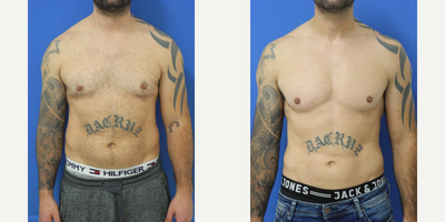25-34 year old man treated with Pec Implants - 34 year old male from Ontario, Canada 1 1/2 years after pec implants performed by Dr Sam Gershenbaum. He had soft, solid vertical rectangular implants placed under the muscle. He requested a natural and athletic look. Needless to say, he was very pleased with his results.