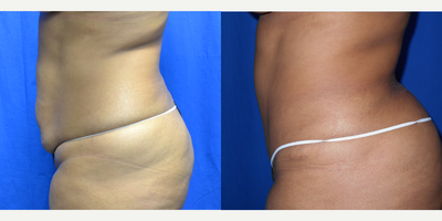 35-44 year old woman treated with Tummy Tuck - 39 year old female after tummy tuck. She is 5'3 and weighs 159 lbs. She had two children and had 2 c-sections. The c-section scars were removed during the tummy tuck.