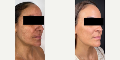 25-34 year old woman treated with Neo Laser - This patient had amazing results with the following treatments:- RX Clear and Brilliant, 2 sessions- NeoAerolase Melasma, 3 sessions
