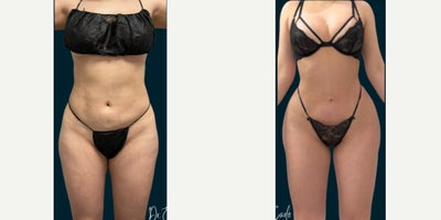 35-44 year old woman treated with Rib Remodeling and Brazilian Butt Lift - Liposuction 360 with Vaser and Fat Transfer to the Buttocks and Hips using Ultrasound Guided Technology and Rib Remodeling