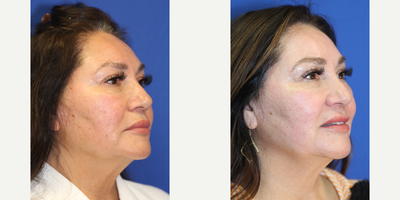 55-64 year old woman treated with Chemical Peel - This is a 57 year old Hispanic patient who was not happy with the uneven skin coloring, fine lines, and dark spots in her face. She had a chemical peel with Dr. J. Timothy Katzen in Beverly Hills, CA.  Notice the improvement in her skin, improved fine lines and dark spots.