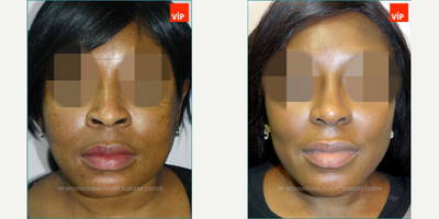 [African American Rhinoplasty] 25-34 year old woman treated with African American Rhinoplasty - Surgery: Combination Rhinoplasty (Septal Cartilage + Silicone Implant) + Mid-face AugmentationSymptoms: Septal Deviation, Wide Nostrils, Sunken Mid face