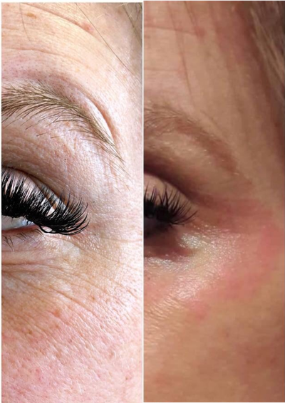 45-54 year old woman treated with Laser Treatment - Plasma Fibroblast Crows Feet