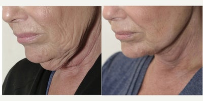 67 year old woman treated with MyEllevate, Mini Facelift - 67 year old female 10 days following the MyEllevate Plus procedure involving placement of the MyEllevate suture support system to define the mandibular border, liposuction of the neck and division of the platysma bands, and a mini-lift skin excision.