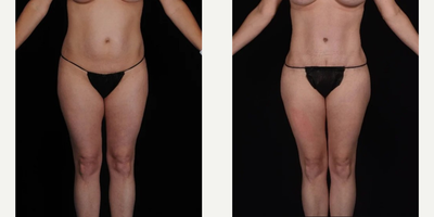 35-44 year old woman treated with SAFELipo - This patient received SAFEliposuction in our practice.