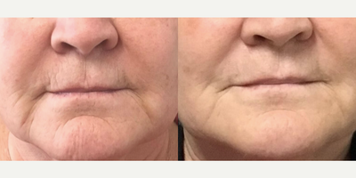 65-74 year old woman treated with Profound RF - After photo was taken 4 weeks after treatment. Optimal results appear 6 months post treatment.&nbsp;