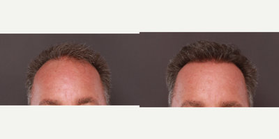 55-64 year old man treated with Hair Transplant, FUE Hair Transplant, Alastin Skincare - 2000 graft hair transplant