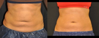 30 Year Old Female. Upper Abdomen and Love Handles treated. One Coolsculpting treatment.  - 
	8 weeks post-treatment. No weight loss.

