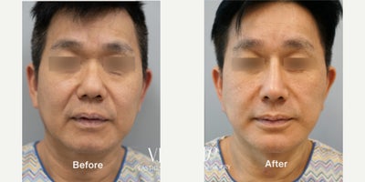 55-64 year old man treated with Deep Plane Facelift, Facelift, SMAS Facelift, Neck Lift, Rhinoplasty, Asian Rhinoplasty - 1.5 year post operative surgery before and after for 60-year-old male patientSurgery List:Extended deep plane facelift, NeckliftMiddle neck plication, Deep neck surgeryRib cartilage rhinoplasty, Mid face augmentationGenioplasty, Endoscopic forehead & brow liftPerformed by VIP Plastic Surgery chief surgeon, Dr. Myung Ju Lee