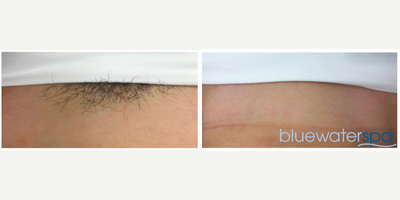 25-34 year old woman treated with Laser Hair Removal - Laser hair removal of the bikini area.