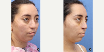 Woman treated with Rhinoplasty, Cleft Lip and Palate repair - Woman treated with Rhinoplasty, Cleft Lip and Palate repair