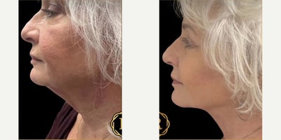 Woman treated with Facelift - Woman treated with Facelift.