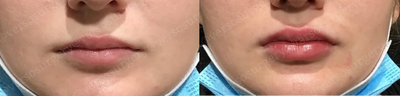 Woman treated with Lip Fillers - Woman treated with Lip Fillers