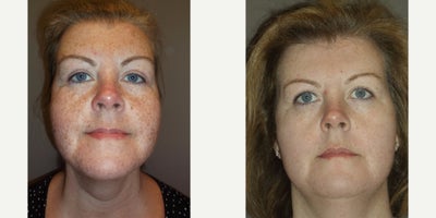 45-54 year old woman treated with PicoSure - Picosure patient. All her freckles are gone
