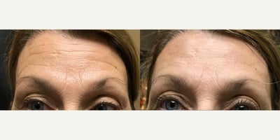 55-64 year old woman treated with Vampire Facelift - Patient shown before and 2 weeks after Neuromodulator injections Microneedling with PRP treatment and Belotero Injections to soften forehead lines.
