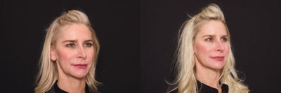 Woman treated with Bellafill - Woman treated with Bellafill