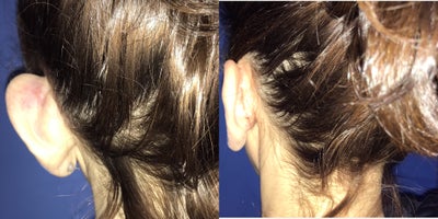 45-54 year old woman treated with Ear Surgery - Patient is 8 months post op her otoplasty surgery