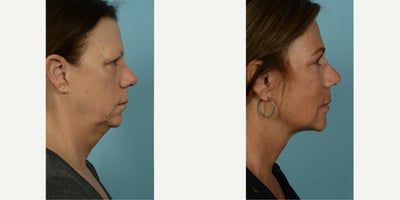 55-64 year old woman treated with Facelift, Lower Facelift, Neck Lift, Laser Resurfacing, Dermabrasion - At age 62, this patient sought to make her outward appearance better reflect her active and vibrant lifestyle. After having her primary facelift over a decade ago, she decided to pursue another procedure, opting for a secondary deep plane facelift, along with perioral fat grafting and ablative laser with spot dermabrasion around her mouth. She selected 'Facelift/Minilift by Dr. Mustoe in Chicago' due to his expertise and innovative approach to these techniques. The patient wanted to tighten her neck and soften deep wrinkles and lines, aiming for a more youthful look which is compatible with her energetic outdoor activities and regular boating adventures.The procedures were meticulously carried out under local anesthesia and oral sedation in Dr. Mustoe's office, negating the need for drains, a testament to his innovative technique. This patient's zest for life was reflected in her quick recovery, as she was back socializing with her friends effortlessly just four days post-procedure. She reported finding the recovery process smooth and easy, and is delighted with her refreshed and rejuvenated appearance.