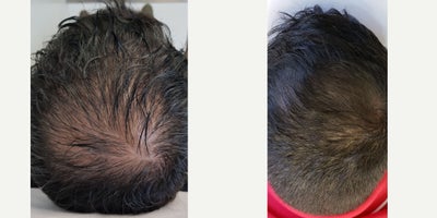 35-44 year old man treated with PRP for Hair Loss, PRP Injections, Hair Loss Treatment, Microneedling, Photodynamic Therapy - This patient underwent a combination treatment in which we used PRP injection, microneedling and photodynamic therapy