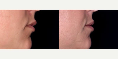 33 year old woman treated with Lip Fillers (Restylane Kysse) - 33 year old woman treated with Lip Fillers (Restylane Kysse) Photos depict before and 1 month after 1 syringe to lips.