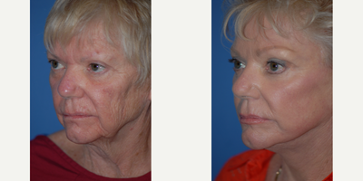 55-64 year old woman treated with Laser Resurfacing - The CO2 laser does a great job of smoothing deep facial wrinkles
