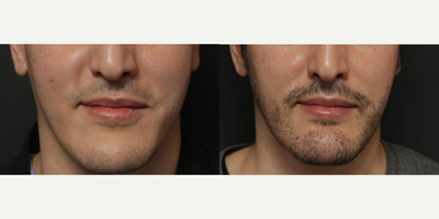 25-34 year old man treated with Beard Transplant - FUE 2500 before and after