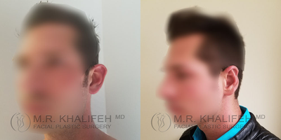Man treated with Ear Surgery - Awake 3 hour local aneshtesia otoplasty consisting of mustarde and conchomastoid suturing to reshape the ear.