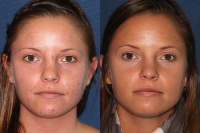 Before and After PDT - 
	Patient underwent Photodynamic Therapy.
