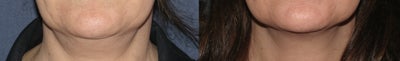 Ulthera Neck | Before and After - 
	Patient underwent Ulthera therapy.
