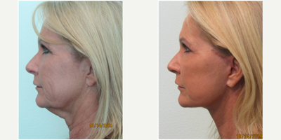 55-64 year old woman treated with Neck Lift and Lower Facelift - This active business woman presented with the complaint of excessive skin laxity and a waddle under her chin.  She had attempted numerous alternative treatments (ie kybella and ultherapy) without success.  She wished for a procedure that would be more effective in eliminating her turkey neck.  We decided together to perform a necklift and lower facelift under local anesthesia in our office.  She was premedicated with valium in order to relax during the procedure.  The treatment time was slightly under 2 hours time and she was back to work in full capacity in 2 weeks time.  Her result demonstrates marked improvement in her profile, elimination of her turkey neck, and improvement in the contour of her jawline and lower face.