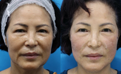55-64 year old woman treated with EndyMed 3Deep - EndyMed 3Deep before and after