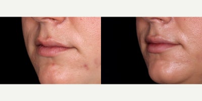 33 year old woman treated with Restylane  - 33 year old woman treated with Lip Fillers (Restylane Kysse) Photos depict before and 1 month after 1 syringe to lips.